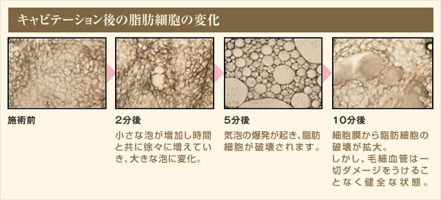 キャビテーション後の脂肪細胞変化