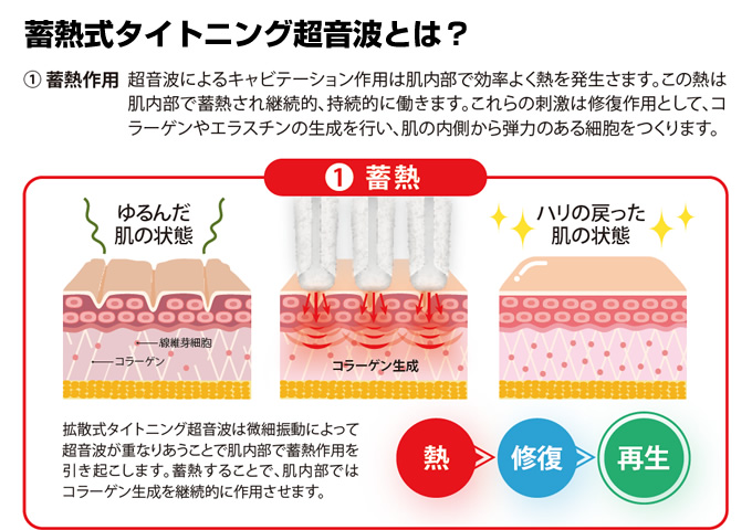 蓄熱式タイトニング超音波とは？